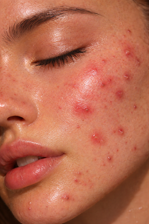Acne-Prone Skin
